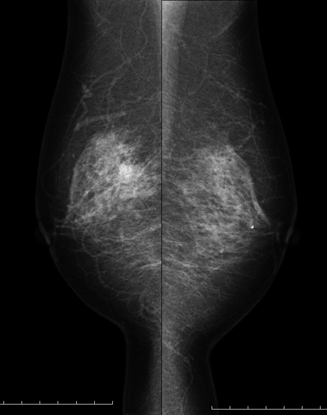 症例16 62歳 女性 粘液癌 純型 マンモグラフィ MLO