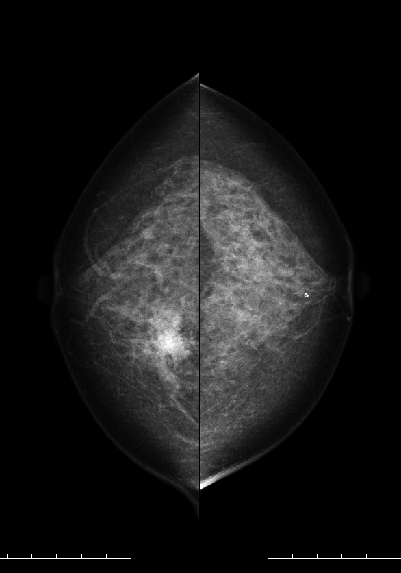 症例16 62歳 女性 粘液癌 純型 マンモグラフィ CC
