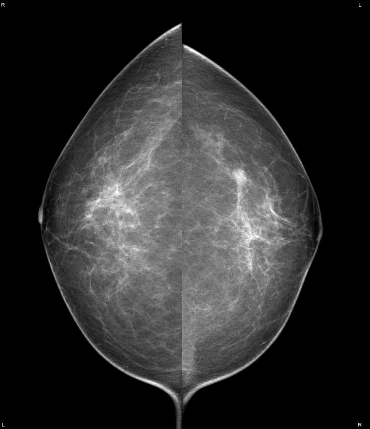 症例17 70歳 女性 浸潤性乳管癌 硬癌 マンモグラフィ CC