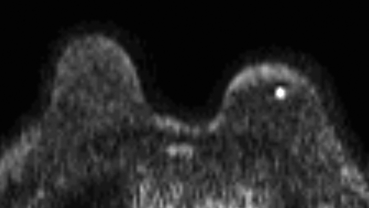 症例17 70歳 女性 浸潤性乳管癌 硬癌 MRI拡散強調画像